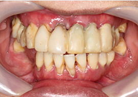 Dental Implant Case Study Harley Street Dental Clinic