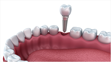 Dental Implants Harley Street